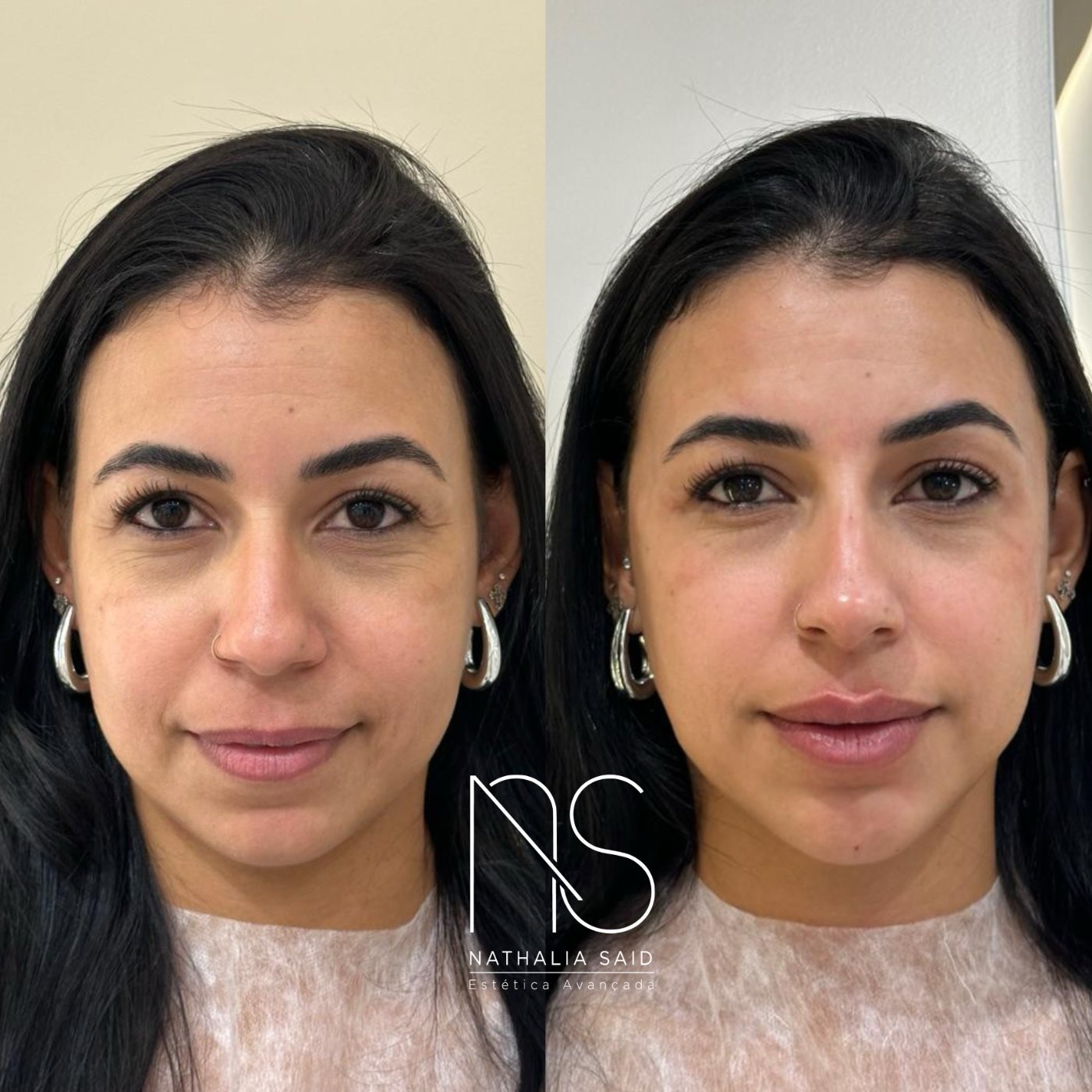 Antes e depois, com discrição