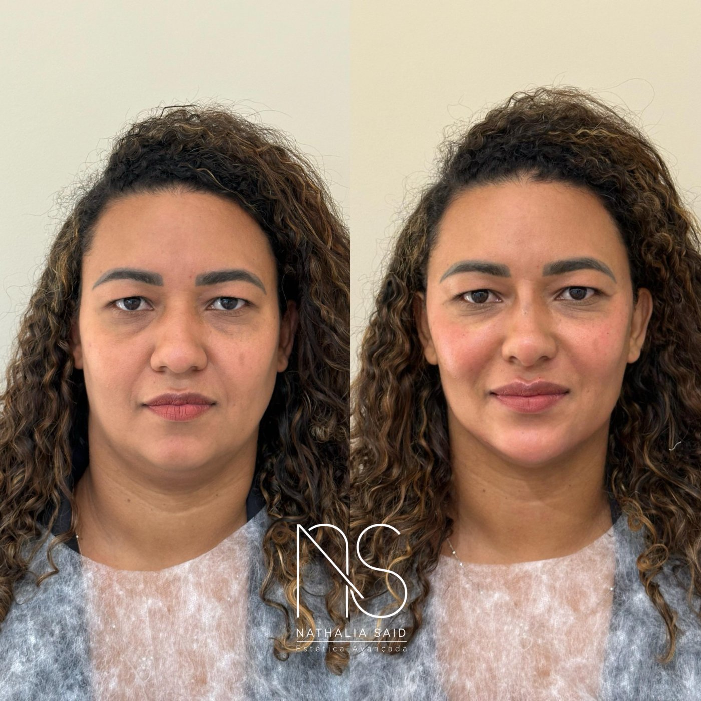 Antes e depois, com discrição