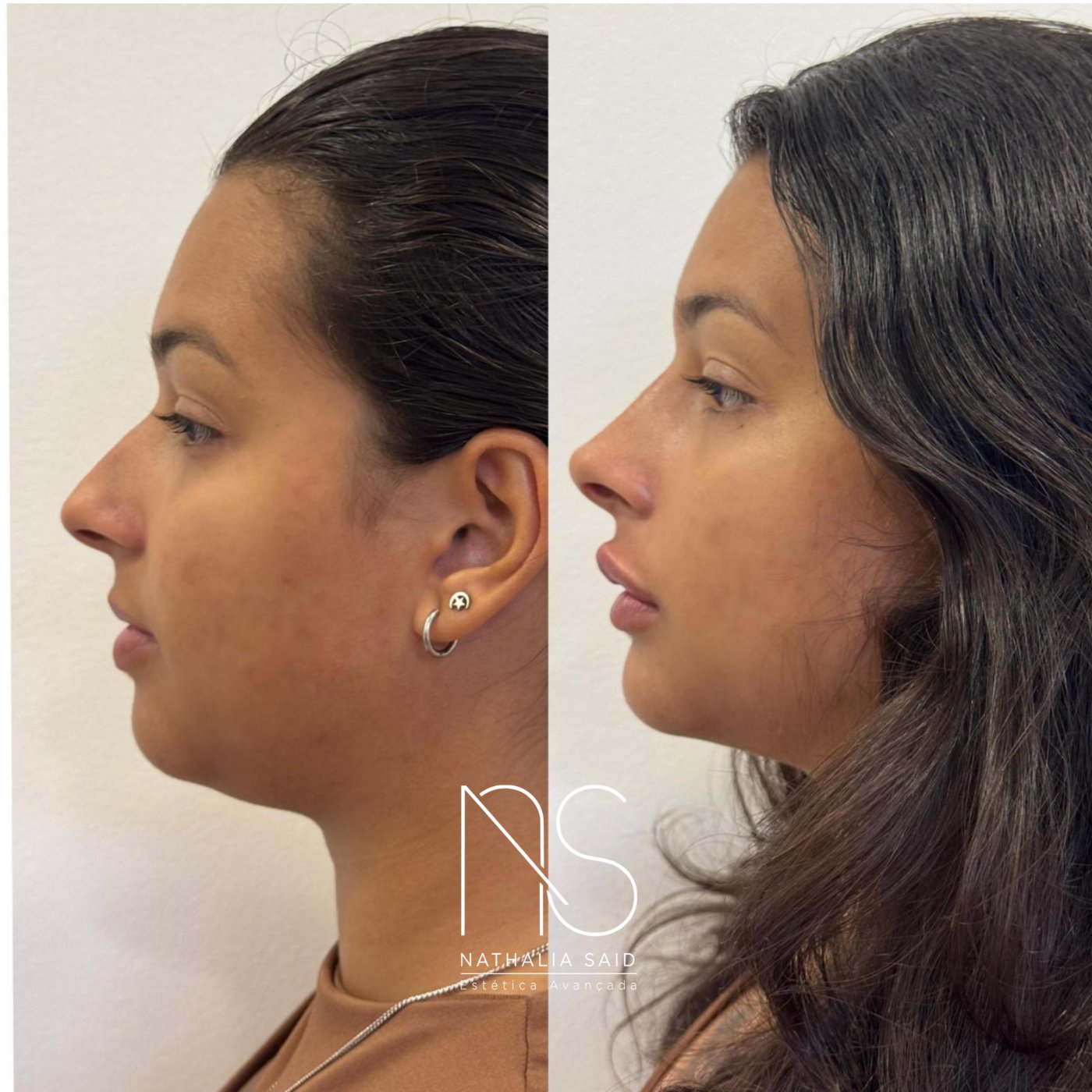 Antes e depois, com discrição